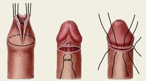 Penis estetiği ameliyatı nasıl yapılır