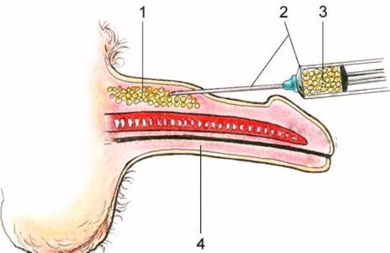 enjeksiyon penis büyütme